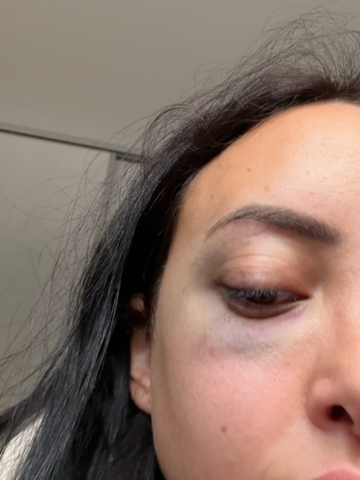 El ojo herido de Karen, en una foto difundida por la mujer.
