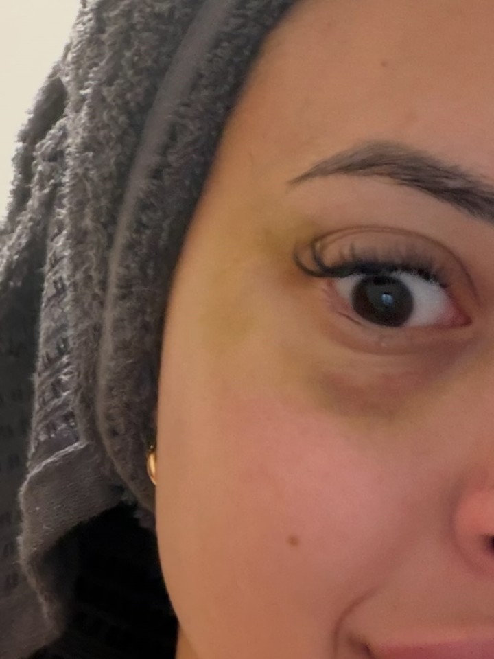 El ojo herido de Karen, en una foto difundida por ella y que atribuye a golpes del jugador.